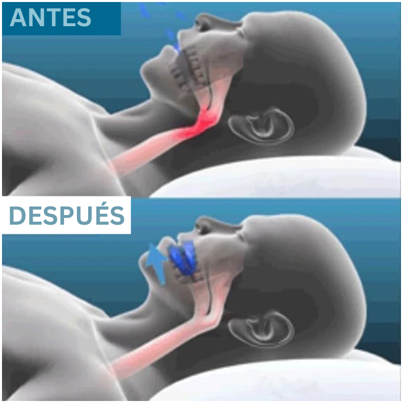 Noctivare Anti-Snoring